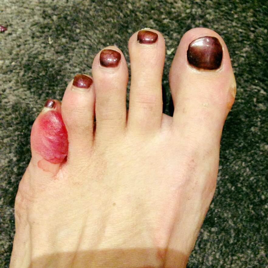 Blisters Between Toes 7 Expert Ways to Prevent Blisters Between Toes