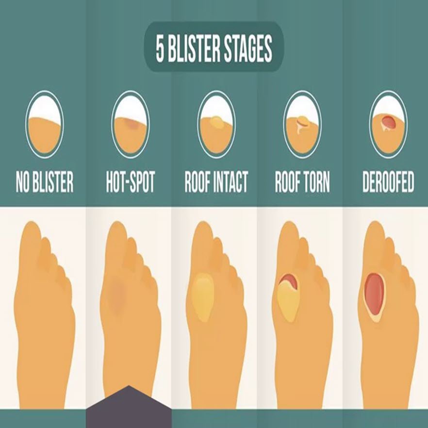 Heal foot blister fast on sale
