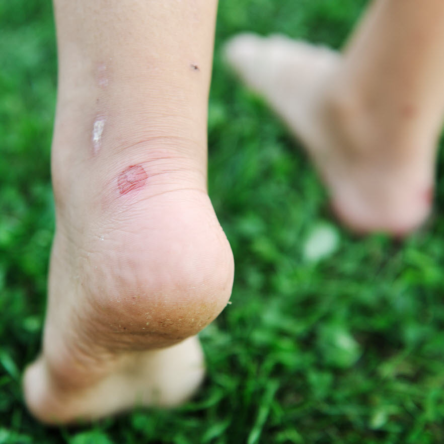 Are Blisters Inevitable